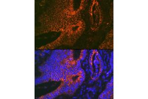 Immunofluorescence analysis of human colon carcinoma using  Rabbit mAb (ABIN7265434) at dilution of 1:100 (40x lens).