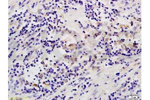 Formalin-fixed and paraffin embedded human colon carcinoma labeled with Anti-MAP3K8/TPL2 Polyclonal Antibody, Unconjugated  at 1:200 followed by conjugation to the secondary antibody and DAB staining. (MAP3K8 anticorps  (AA 121-220))