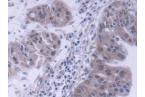 DAB staining on IHC-P; Samples: Human Liver cancer Tissue (DP1 anticorps  (AA 6-410))