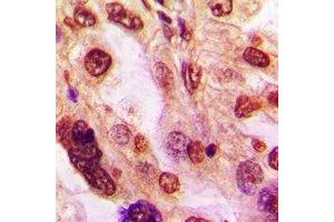 Immunohistochemical analysis of ZFP36L2 staining in human lung cancer formalin fixed paraffin embedded tissue section. (ZFP36L2 anticorps)