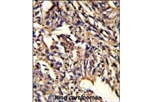 Formalin-fixed and paraffin-embedded human lung carcinoma reacted with PSMD13 Antibody (C-term), which was peroxidase-conjugated to the secondary antibody, followed by DAB staining.
