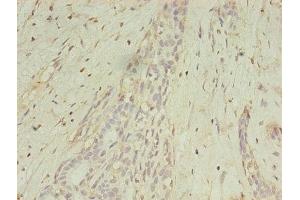 Immunohistochemistry of paraffin-embedded human breast cancer using ABIN7159252 at dilution of 1:100