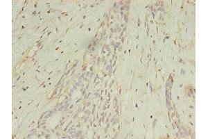 Immunohistochemistry of paraffin-embedded human breast cancer using ABIN7159252 at dilution of 1:100 (MAGEA1 anticorps  (AA 2-225))