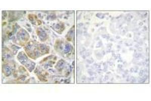 Immunohistochemistry analysis of paraffin-embedded human breast carcinoma tissue using ITGB4 (Ab-1510) antibody.