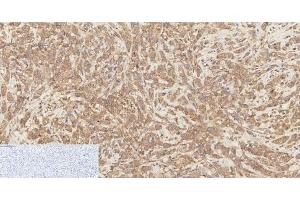 Immunohistochemistry of paraffin-embedded Human breast cancer tissue using Phospho-Catenin beta (Ser37) Polyclonal Antibody at dilution of 1:200