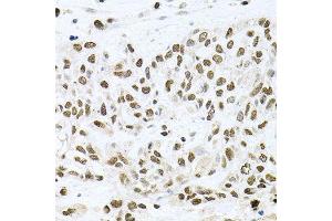 Immunohistochemistry of paraffin-embedded human lung cancer using BCCIP antibody (ABIN5995871) at dilution of 1/100 (40x lens).