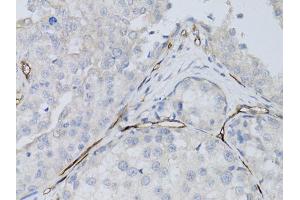 Immunohistochemistry of paraffin-embedded human breast cancer using CD34 antibody. (CD34 anticorps)
