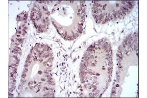 Immunohistochemical analysis of paraffin-embedded colon cancer tissues using HOXB4 mouse mAb with DAB staining. (HOXB4 anticorps  (AA 16-251))