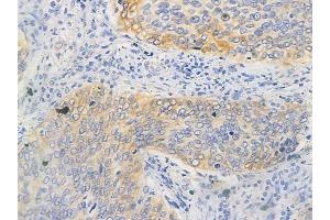 ABIN6263203 and ABIN6266781 at 1/100 staining human pancreatic carcinoma by IHC-P. (MEF2C anticorps  (C-Term))