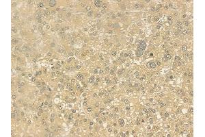 ABIN6262303 and ABIN6276781 at 1/100 staining human hepatocellular carcinoma by IHC-P. (HMGCR anticorps  (N-Term))