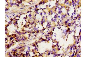Immunohistochemistry of paraffin-embedded human gastric cancer using ABIN7170131 at dilution of 1:100 (SLC22A1 anticorps  (AA 43-149))