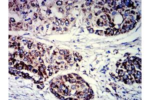 Immunohistochemical analysis of paraffin-embedded ovarian cancer tissues using PIGR mouse mAb with DAB staining. (PIGR anticorps  (AA 19-170))