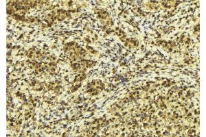 ABIN6272531 at 1/100 staining Human breast cancer tissue by IHC-P.