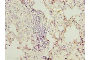 Immunohistochemistry of paraffin-embedded human lung cancer using ABIN7174654 at dilution of 1:100 (OGT anticorps  (AA 606-1022))