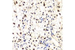 Immunohistochemistry of paraffin-embedded human kidney cancer using NFKBIB antibody (ABIN6130475, ABIN6144584, ABIN6144585 and ABIN6221459) at dilution of 1:200 (40x lens). (NFKBIB anticorps  (AA 1-356))