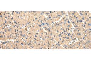 Immunohistochemistry of paraffin-embedded Human liver cancer tissue using DUSP11 Polyclonal Antibody at dilution 1:50 (DUSP11 anticorps)