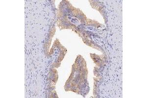 Immunohistochemical staining of human prostate with TCHHL1 polyclonal antibody  shows moderate cytoplasmic positivity in glandular cells. (TCHHL1 anticorps)