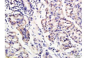 Formalin-fixed and paraffin embedded human gastritis labeled with Rabbit Anti TREM2 Polyclonal Antibody, Unconjugated (ABIN749678) at 1:200 followed by conjugation to the secondary antibody and DAB staining (TREM2 anticorps  (AA 1-100))