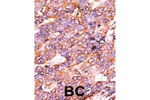 Immunohistochemistry (Formalin/PFA-fixed paraffin-embedded sections) of human breast carcinoma with Histone H3 (phospho S10) polyclonal antibody , followed by peroxidase-conjugated secondary antibody and AEC staining. (Histone H3.3 anticorps  (pSer10))