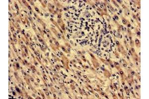 Immunohistochemistry analysis of human liver cancer using ABIN7172382 at dilution of 1:100 (MECR anticorps  (AA 211-373))