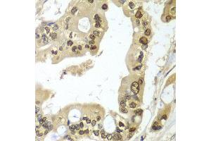 Immunohistochemistry of paraffin-embedded human liver cancer using UBE2B antibody at dilution of 1:100 (x40 lens).