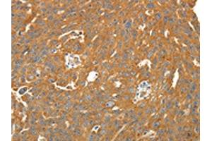 The image on the left is immunohistochemistry of paraffin-embedded Human ovarian cancer tissue using ABIN7131067(SIRT4 Antibody) at dilution 1/25. (SIRT4 anticorps)