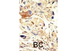 Formalin-fixed and paraffin-embedded human cancer tissue reacted with the primary antibody, which was peroxidase-conjugated to the secondary antibody, followed by AEC staining. (EGFR anticorps  (N-Term))