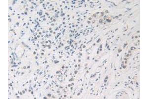 IHC-P analysis of Human Stomach Cancer Tissue, with DAB staining. (FDFT1 anticorps  (AA 269-417))