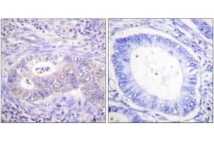 Immunohistochemistry analysis of paraffin-embedded human colon carcinoma, using PFKFB2 (Phospho-Ser483) Antibody.