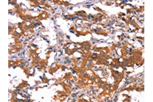 The image on the left is immunohistochemistry of paraffin-embedded Human thyroid cancer tissue using ABIN7190910(HCAR2 Antibody) at dilution 1/40, on the right is treated with synthetic peptide. (HCAR2 anticorps)