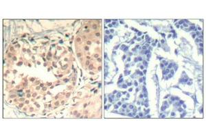 Immunohistochemical analysis of paraffin-embedded human breast carcinoma tissue using CDK6(Phospho-Tyr13) Antibody(left) or the same antibody preincubated with blocking peptide(right). (CDK6 anticorps  (pTyr13))