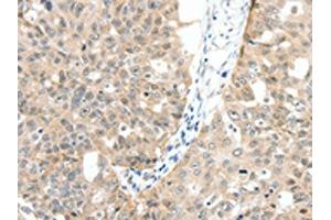 The image on the left is immunohistochemistry of paraffin-embedded Human ovarian cancer tissue using ABIN7130157(MAP3K14 Antibody) at dilution 1/30, on the right is treated with fusion protein. (MAP3K14 anticorps)