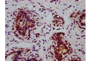 IHC image of ABIN7127690 diluted at 1:100 and staining in paraffin-embedded human breast cancer performed on a Leica BondTM system.