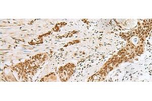 Immunohistochemistry of paraffin-embedded Human esophagus cancer tissue using PNRC2 Polyclonal Antibody at dilution of 1:30(x200)