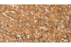 Immunohistochemistry of paraffin-embedded Human liver cancer tissue using SNAP29 Polyclonal Antibody at dilution 1:45 (SNAP29 anticorps)