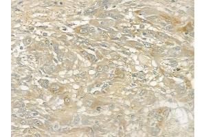 ABIN6260440 and ABIN6272875 at 1/100 staining human tongue carcinoma by IHC-P. (CAMSAP2 anticorps  (C-Term))