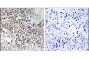 Immunohistochemistry analysis of paraffin-embedded human liver carcinoma tissue, using Cytochrome P450 4Z1 Antibody.