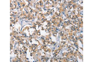 Immunohistochemistry of Human gastric cancer using SCARB1 Polyclonal Antibody at dilution of 1:65 (SCARB1 anticorps)