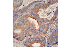 Immunohistochemistry analysis in formalin fixed and paraffin embedded human prostate carcinoma reacted with GLB1L2 Antibody (C-term) followed by peroxidase conjugation of the secondary antibody and DAB staining. (GLB1L2 anticorps  (C-Term))