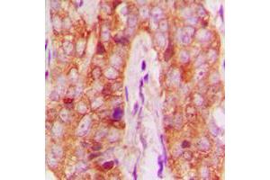Immunohistochemical analysis of MMP13 staining in human breast cancer formalin fixed paraffin embedded tissue section.