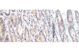 Immunohistochemistry of paraffin-embedded Human gastric cancer tissue using CALB2 Polyclonal Antibody at dilution of 1:25(x200) (Calretinin anticorps)