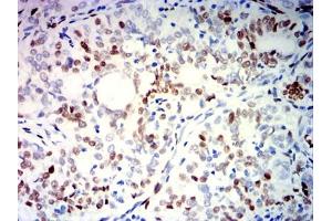 Immunohistochemical analysis of paraffin-embedded cervical cancer tissues using PGR mouse mAb with DAB staining. (Progesterone Receptor anticorps  (AA 166-411))