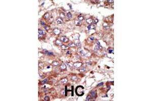 Formalin-fixed and paraffin-embedded human hepatocellular carcinoma tissue reacted with the ACSL6 polyclonal antibody  , which was peroxidase-conjugated to the secondary antibody, followed by AEC staining. (ACSL6 anticorps  (Internal Region))