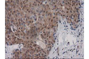 Immunohistochemical staining of paraffin-embedded Adenocarcinoma of Human breast tissue using anti-DSTN mouse monoclonal antibody. (Destrin anticorps)