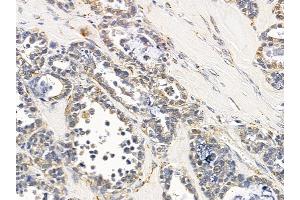 ABIN6258026 and ABIN6275228 at 1/100 staining human ovarian cancer by IHC-P. (CLNS1A anticorps  (C-Term))