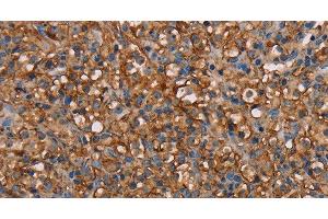 Immunohistochemistry of paraffin-embedded Human prostate cancer tissue using NEDD4L Polyclonal Antibody at dilution 1:60