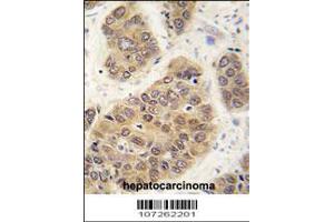 Formalin-fixed and paraffin-embedded human hepatocarcinoma tissue reacted with SUMO4 antibody (M55 Wild type) , which was peroxidase-conjugated to the secondary antibody, followed by DAB staining.