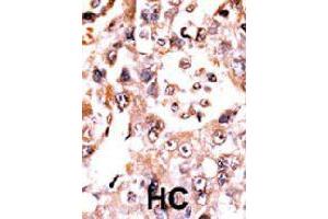 Formalin-fixed and paraffin-embedded human hepatocellular carcinoma tissue reacted with DUSP3 polyclonal antibody  , which was peroxidase-conjugated to the secondary antibody, followed by AEC staining. (Dual Specificity Phosphatase 3 (DUSP3) (N-Term) anticorps)
