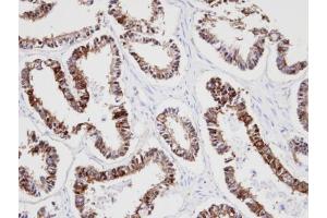 IHC-P Image Immunohistochemical analysis of paraffin-embedded human endo mitral ovarian cancer, using KRT18, antibody at 1:100 dilution. (Cytokeratin 18 anticorps)