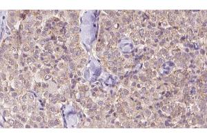 ABIN6273342 at 1/100 staining Human thyroid cancer tissue by IHC-P. (USP9X anticorps  (N-Term))